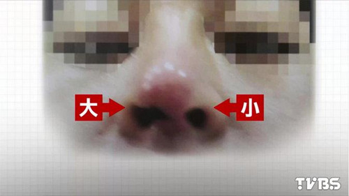 女子隆鼻后鼻子腐烂鼻孔一大一小（图）